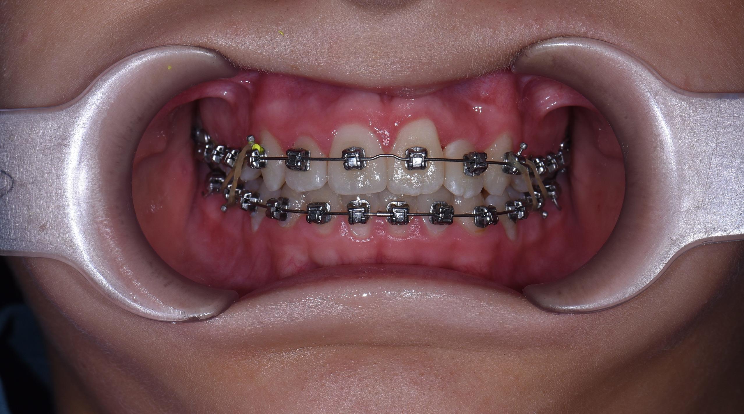 Ортодонтичне лікування металевими брекетами Damon Q фото лікування