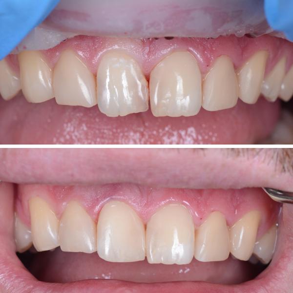 Реставрация 11 зуба с восстановлением анатомической формы, фото до и после лечения